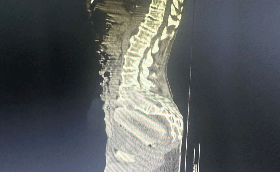 Doctors in Colombia remove giant cassava from 72-year-old man's rectum after intimate mishap - successful surgery performed as medics urge prompt hospital visits.