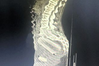 Doctors in Colombia remove giant cassava from 72-year-old man's rectum after intimate mishap - successful surgery performed as medics urge prompt hospital visits.