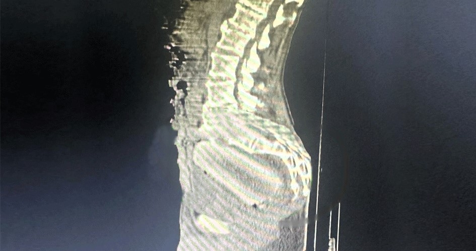 Doctors in Colombia remove giant cassava from 72-year-old man's rectum after intimate mishap - successful surgery performed as medics urge prompt hospital visits.