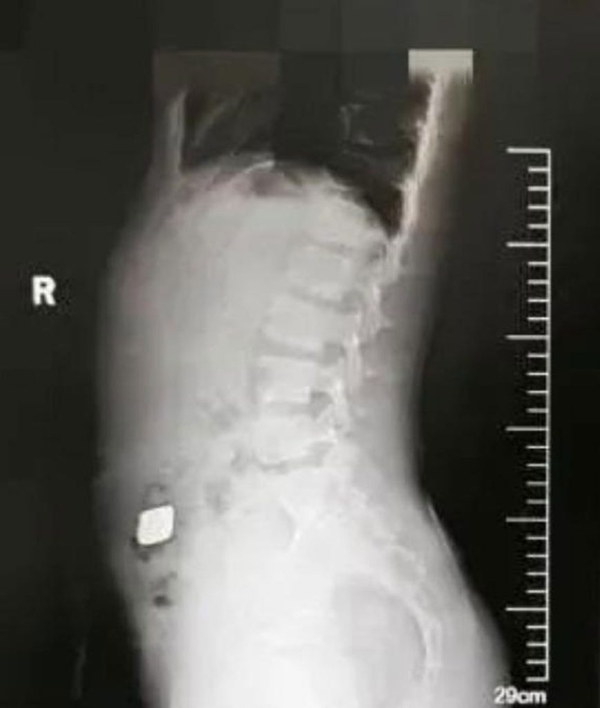 An 11-year-old boy had a £8,000 gold bar surgically removed from his stomach after swallowing it out of curiosity. The 100g bar was intact after a 30-minute operation.