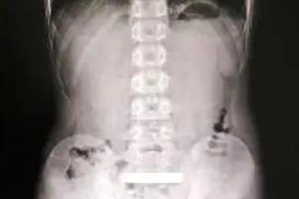 An 11-year-old boy had a £8,000 gold bar surgically removed from his stomach after swallowing it out of curiosity. The 100g bar was intact after a 30-minute operation.