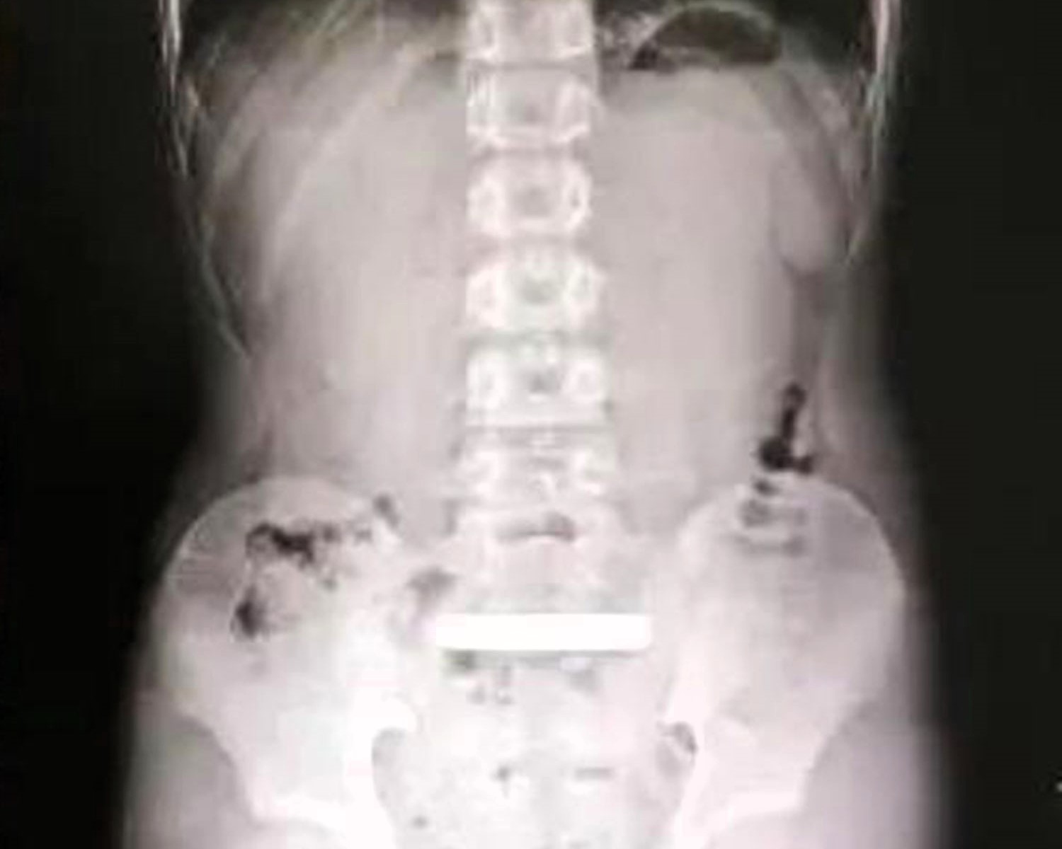 An 11-year-old boy had a £8,000 gold bar surgically removed from his stomach after swallowing it out of curiosity. The 100g bar was intact after a 30-minute operation.