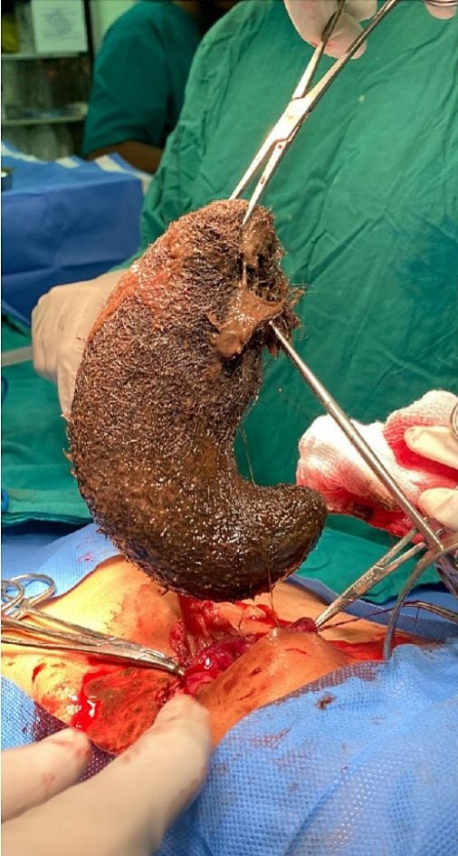 A boy with a history of eating mud and hair had a giant comma-shaped hairball removed from his stomach after suffering hair loss and pain but has now recovered well.