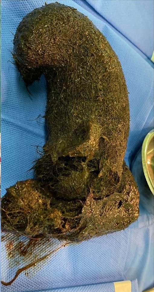A boy with a history of eating mud and hair had a giant comma-shaped hairball removed from his stomach after suffering hair loss and pain but has now recovered well.