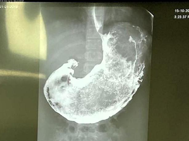 A boy with a history of eating mud and hair had a giant comma-shaped hairball removed from his stomach after suffering hair loss and pain but has now recovered well.