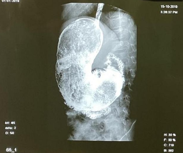 A boy with a history of eating mud and hair had a giant comma-shaped hairball removed from his stomach after suffering hair loss and pain but has now recovered well.