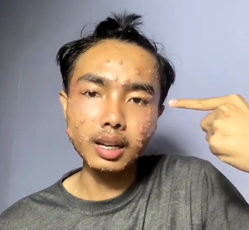 A TikToker contracted molluscum contagiosum after wearing unwashed second-hand clothes, sparking viral concern and highlighting the importance of cleaning thrifted items.