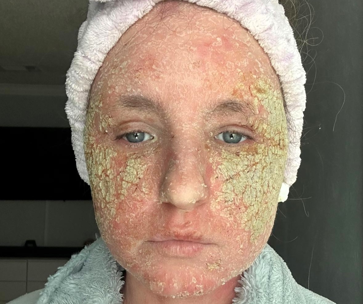 Topical steroid withdrawal left Ineta Petraityte housebound and in agony after years of eczema treatment, forcing a painful recovery journey and move to the Cayman Islands.