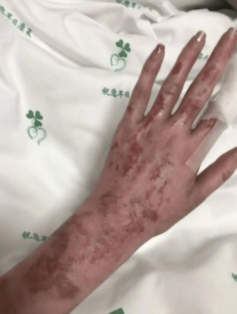 Beauty influencer Tong Yao suffers severe burns in gas blast after dad lights cigarette - parents hospitalized as she shaves head and seeks help with £51K bills.
