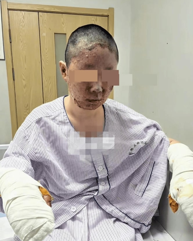 Beauty influencer Tong Yao suffers severe burns in gas blast after dad lights cigarette - parents hospitalized as she shaves head and seeks help with £51K bills.