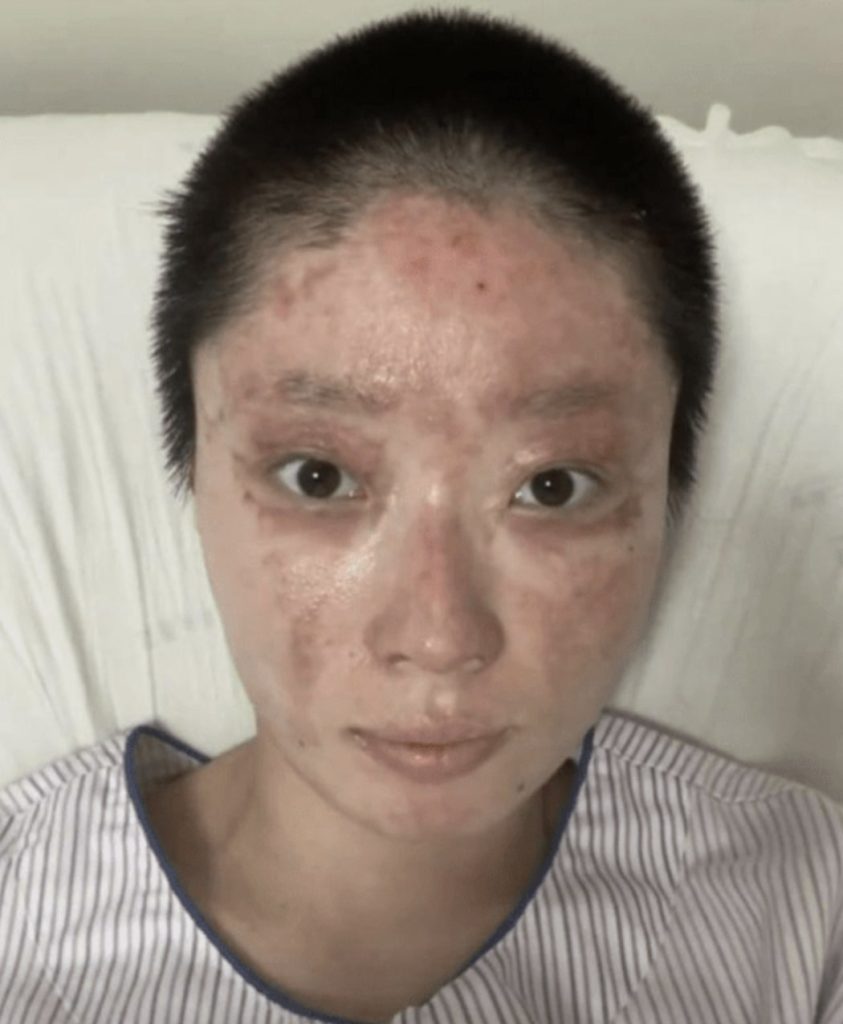Beauty influencer Tong Yao suffers severe burns in gas blast after dad lights cigarette - parents hospitalized as she shaves head and seeks help with £51K bills.