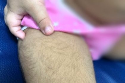 Children treated with vosoritide for dwarfism developed reversible 'werewolf syndrome' due to excess hair growth, with symptoms fading after stopping the medication.