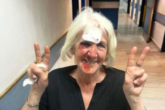 A Brit gran was left unrecognisable after a horror fall on holiday in Greece - now she's warning others to never skip travel insurance after her £66 policy saved her.