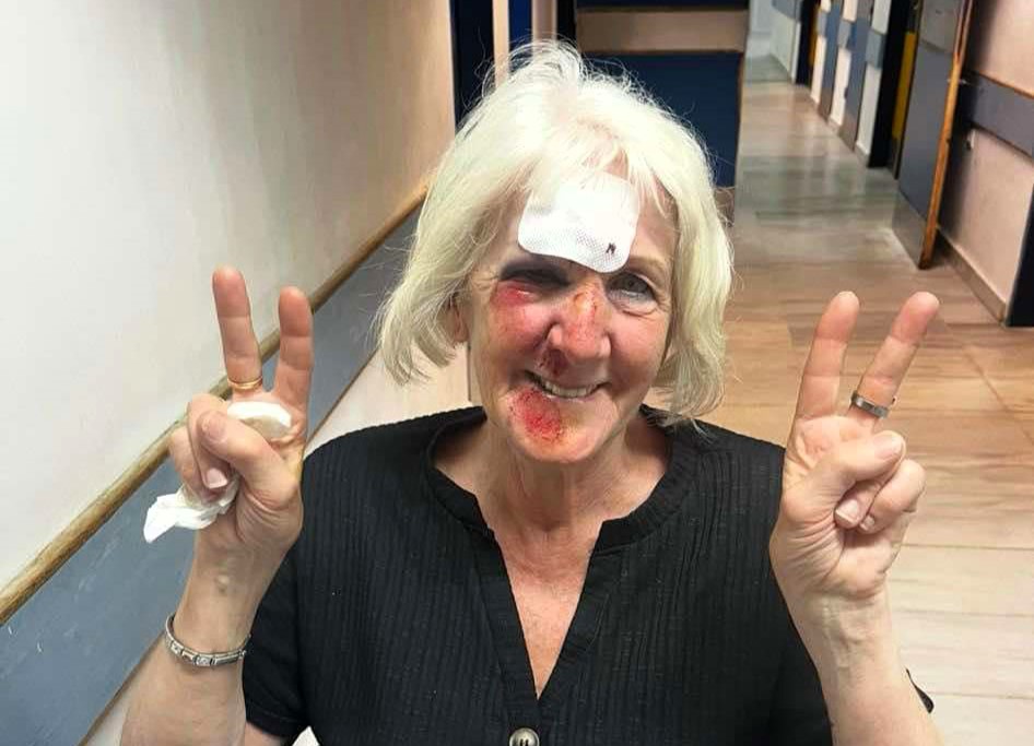 A Brit gran was left unrecognisable after a horror fall on holiday in Greece - now she's warning others to never skip travel insurance after her £66 policy saved her.