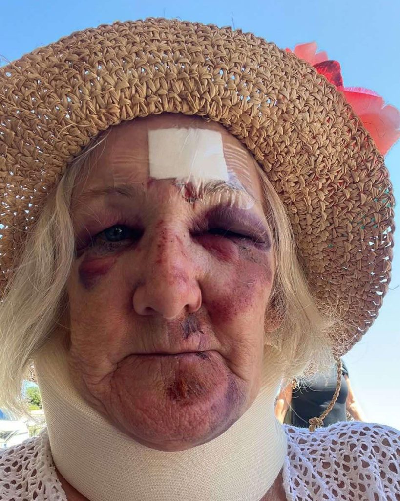 A Brit gran was left unrecognisable after a horror fall on holiday in Greece - now she's warning others to never skip travel insurance after her £66 policy saved her.