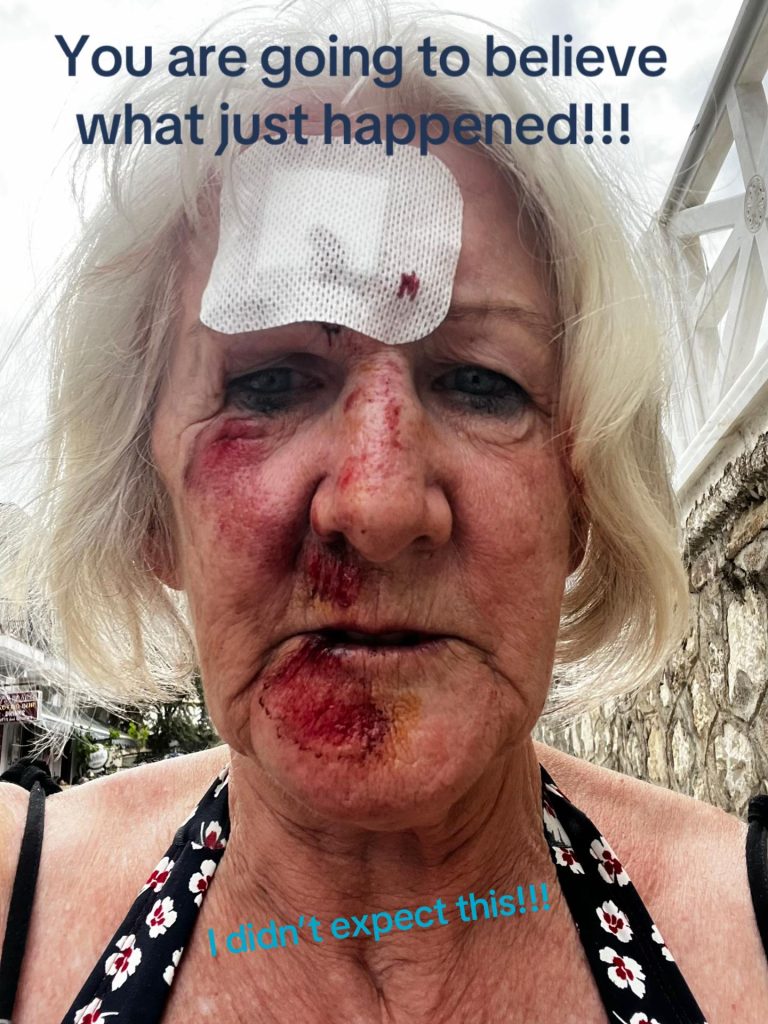 A Brit gran was left unrecognisable after a horror fall on holiday in Greece - now she's warning others to never skip travel insurance after her £66 policy saved her.