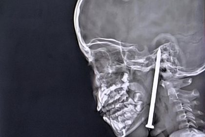 Boy, 7, survives after 8cm nail removed from brain in 10-hour surgery - Indian surgeons hailed heroes as advanced tech helps avoid major vessel by millimetres.