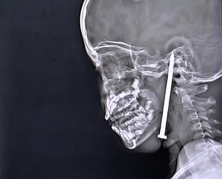 Boy, 7, survives after 8cm nail removed from brain in 10-hour surgery - Indian surgeons hailed heroes as advanced tech helps avoid major vessel by millimetres.