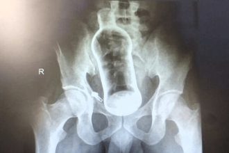 A 30-year-old man needed surgery after inserting a glass bottle into his rectum. Doctors performed a transanal extraction and advised counseling to prevent recurrence.