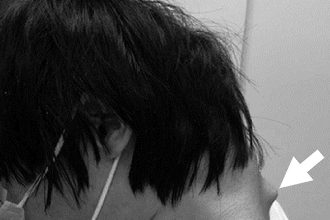 A 25-year-old gamer from Japan developed dropped head syndrome after years of mobile gaming, requiring spine surgery to fix a 90-degree neck bend and restore posture.
