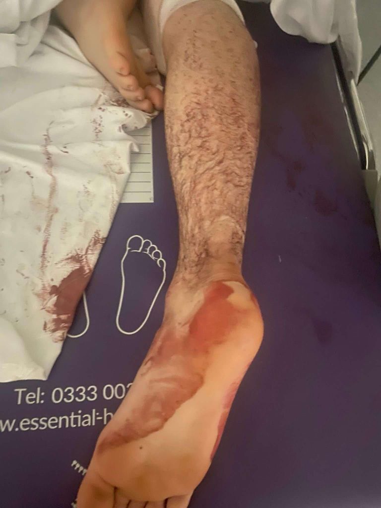 Teen stabbed and £1,000 e-bike stolen in terrifying ambush near Liverpool - mum describes trauma and plans to move after attack left son inches from paralysis.