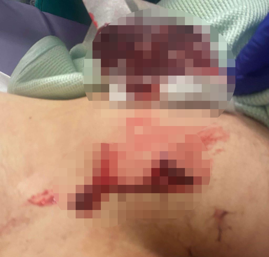 Teen stabbed and £1,000 e-bike stolen in terrifying ambush near Liverpool - mum describes trauma and plans to move after attack left son inches from paralysis.