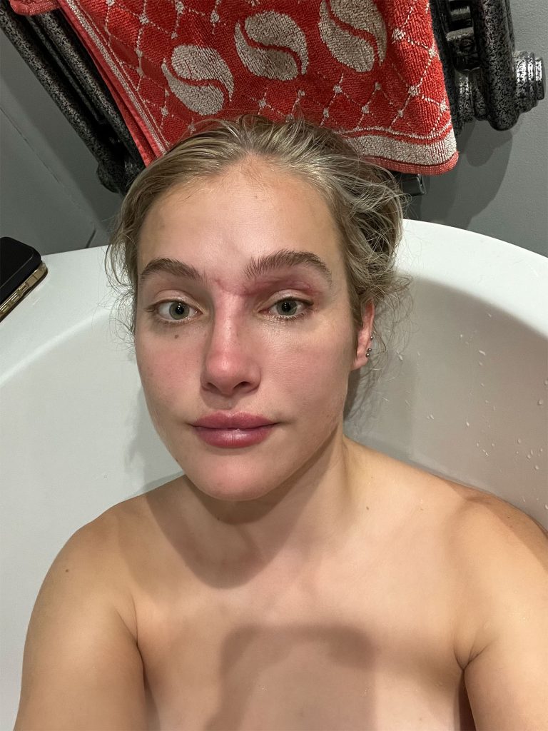 Model Mercedes Valentine says intimacy with her partner while in hospital helped her mentally recover after a horrific motorbike crash that left her with severe injuries.