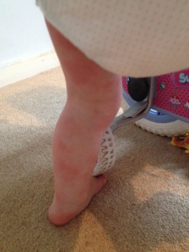 A mum reveals her kids' rare sun allergy that causes extreme pain and risks liver failure - now she fights to raise awareness and connect with others like them.