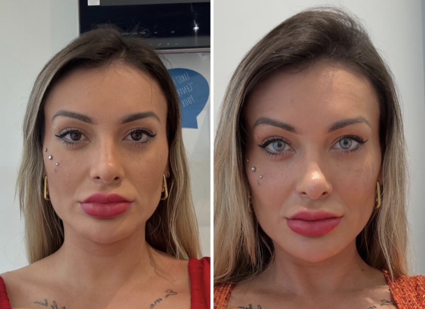Influencer who removed ribs now tattoos eyes green in bold surgery - Andressa Urach fulfills childhood dream with corneal pigment procedure after years of saving.