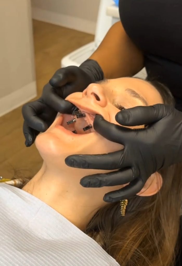 Kate, 33, went toothless for a year after choosing dentures to fix her rotting teeth - now with implants, she says her confidence is back and her life has been transformed.