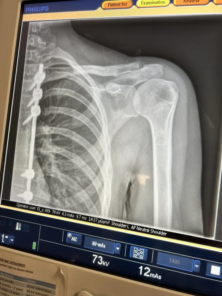 Mum warns parents after daughter, 16, diagnosed with rare silent cancer - a grapefruit-sized lump revealed aggressive SEF with few treatments and a five-year prognosis.