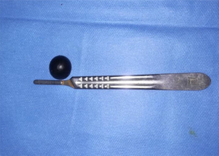 Doctors remove plastic chip lodged near man's eye after high velocity trauma - emergency surgery saves vision with no lasting damage in rare orbital injury case.