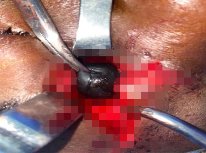Doctors remove plastic chip lodged near man's eye after high velocity trauma - emergency surgery saves vision with no lasting damage in rare orbital injury case.