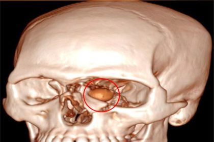 Doctors remove plastic chip lodged near man's eye after high velocity trauma - emergency surgery saves vision with no lasting damage in rare orbital injury case.