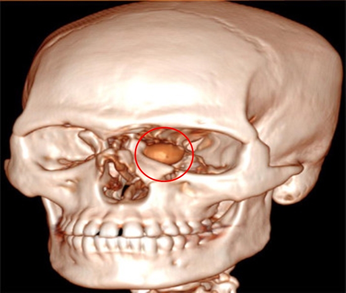 Doctors remove plastic chip lodged near man's eye after high velocity trauma - emergency surgery saves vision with no lasting damage in rare orbital injury case.