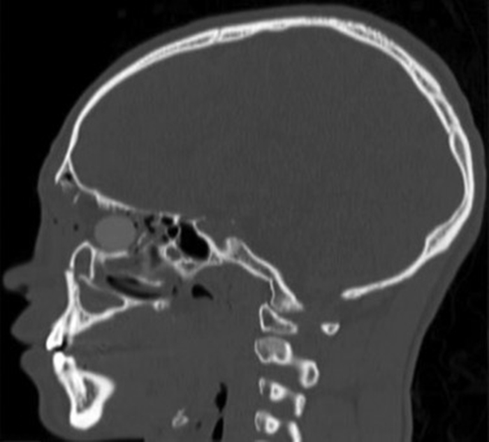 Doctors remove plastic chip lodged near man's eye after high velocity trauma - emergency surgery saves vision with no lasting damage in rare orbital injury case.