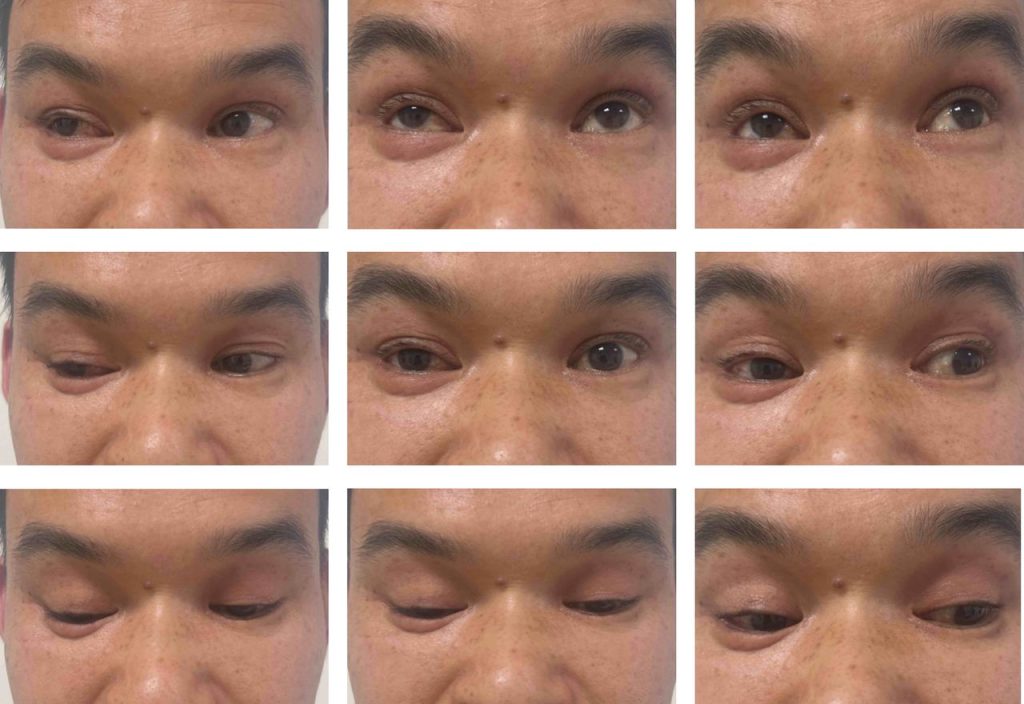 A fisherman had a 9cm lead sinker launched into his eye during a trip, needing emergency surgery in Shanghai - he survived but was left with severely reduced vision.
