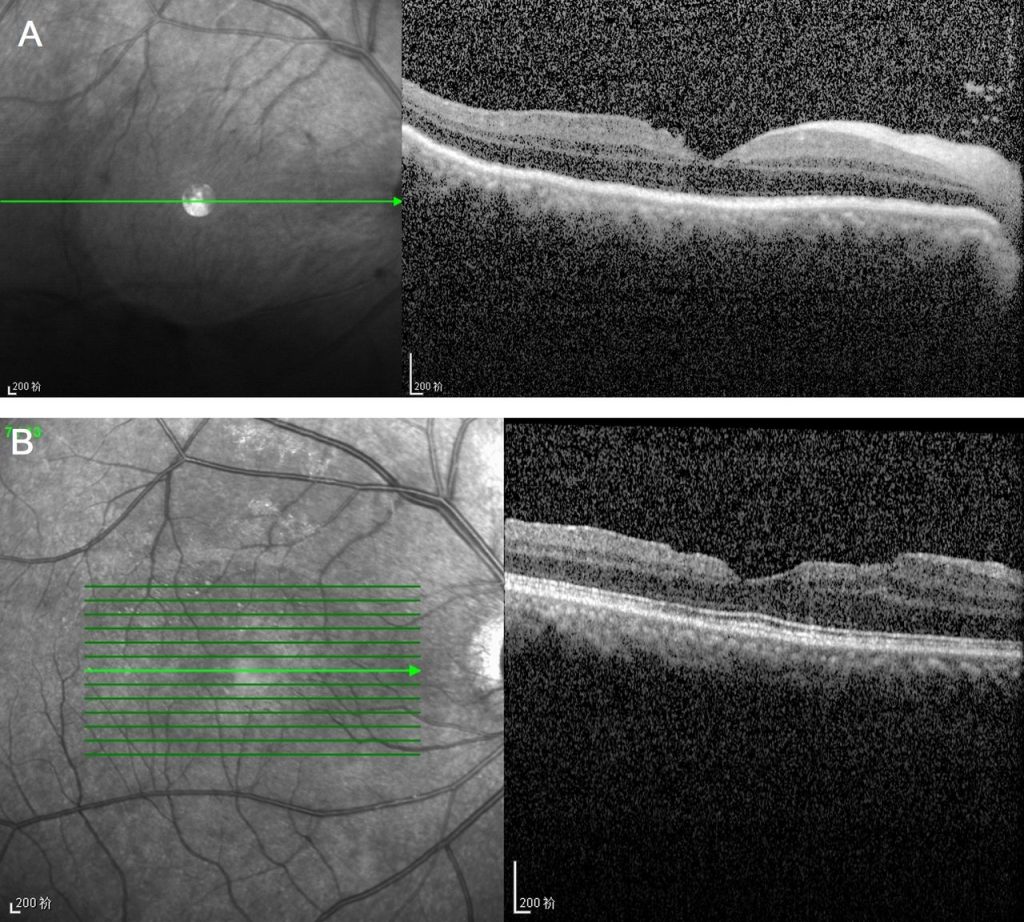 A fisherman had a 9cm lead sinker launched into his eye during a trip, needing emergency surgery in Shanghai - he survived but was left with severely reduced vision.