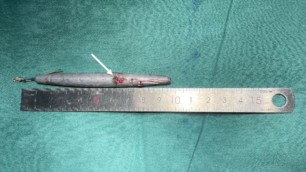 A fisherman had a 9cm lead sinker launched into his eye during a trip, needing emergency surgery in Shanghai - he survived but was left with severely reduced vision.