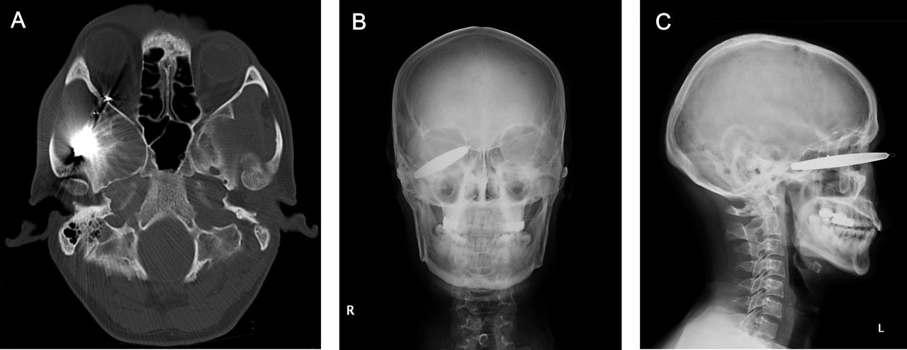 A fisherman had a 9cm lead sinker launched into his eye during a trip, needing emergency surgery in Shanghai - he survived but was left with severely reduced vision.