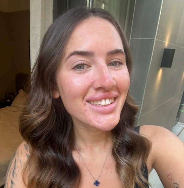 Air hostess gets trolled after spending £3.6k on Turkey teeth makeover with extra white crowns - critics slam the look but she says it boosted her confidence.