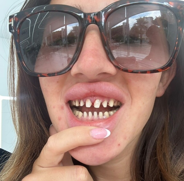 Air hostess gets trolled after spending £3.6k on Turkey teeth makeover with extra white crowns - critics slam the look but she says it boosted her confidence.
