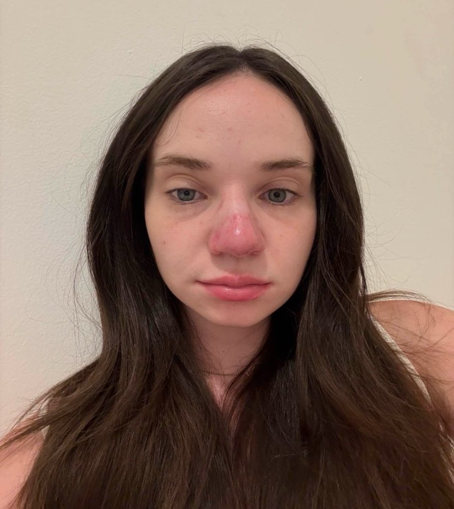 Woman’s nose turns red after sunburn and stays that way for 5 years - baffling condition stumps doctors, ruins confidence and sparks constant questions from strangers.