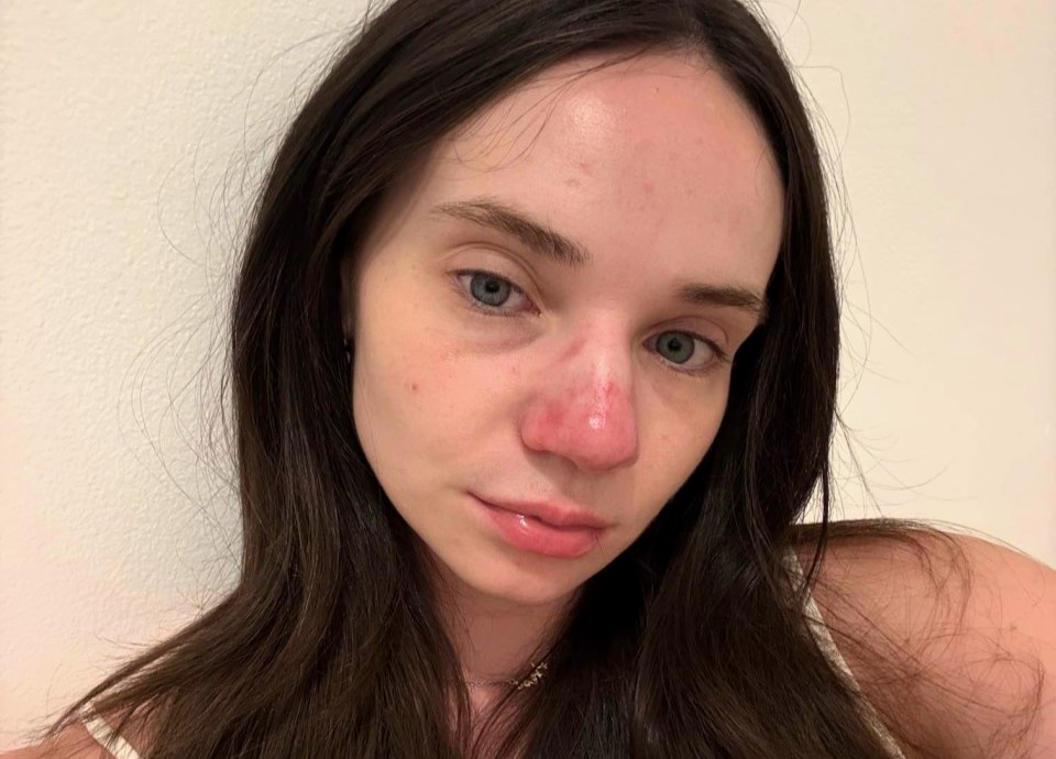 Woman’s nose turns red after sunburn and stays that way for 5 years - baffling condition stumps doctors, ruins confidence and sparks constant questions from strangers.