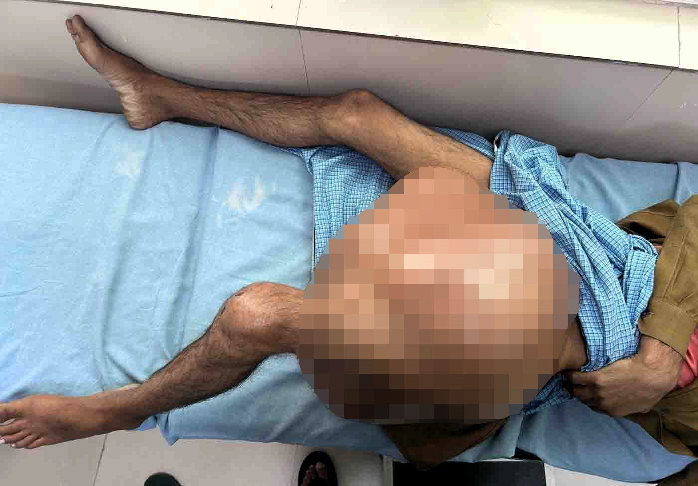 Man has 5st 5lb tumour removed from leg in life-saving surgery for rare bone cancer - six-hour operation at AIIMS Rishikesh restores mobility and hope after years of pain.