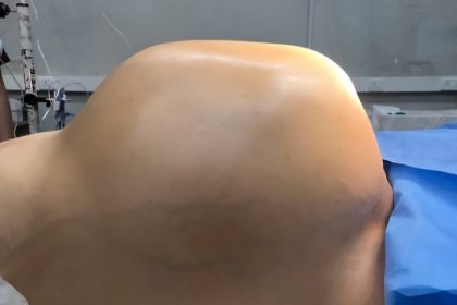 A man in India had a 23lb tumour removed after months of agony and organ compression. The risky surgery was successful, and he's now recovering under close medical watch.