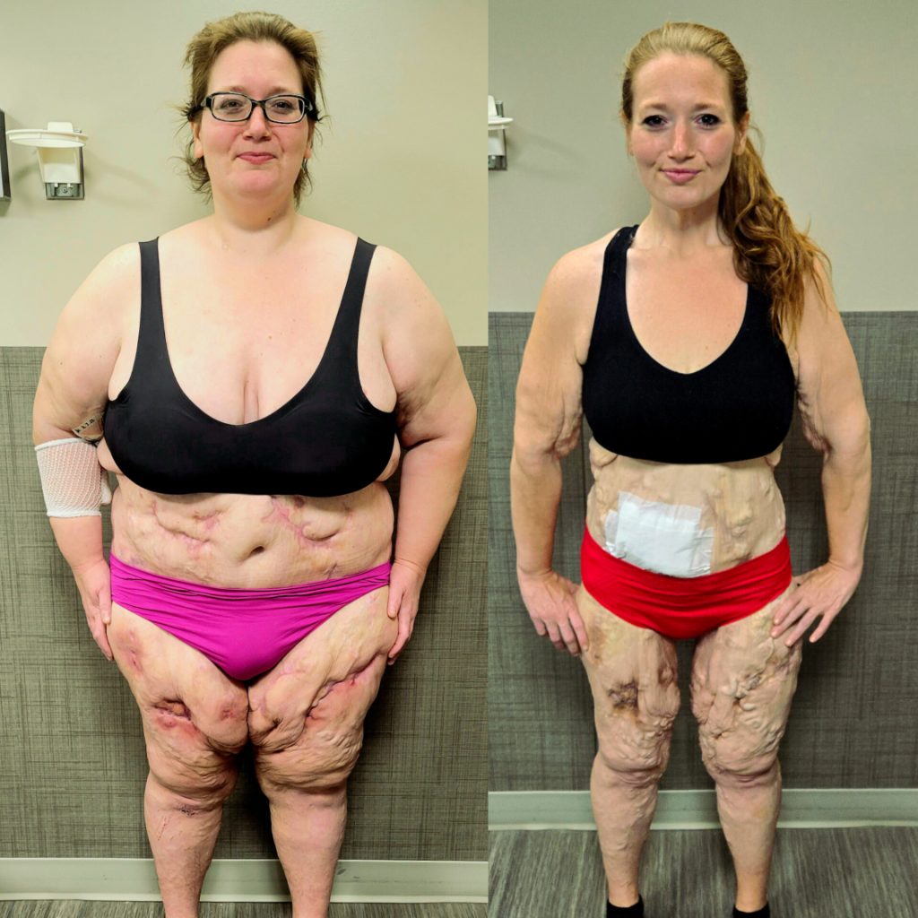 Lexi Reed lost 312lbs and now embraces her body with scars and loose skin from her battle with calciphylaxis - proud in swimsuits but unable to swim due to open wounds.