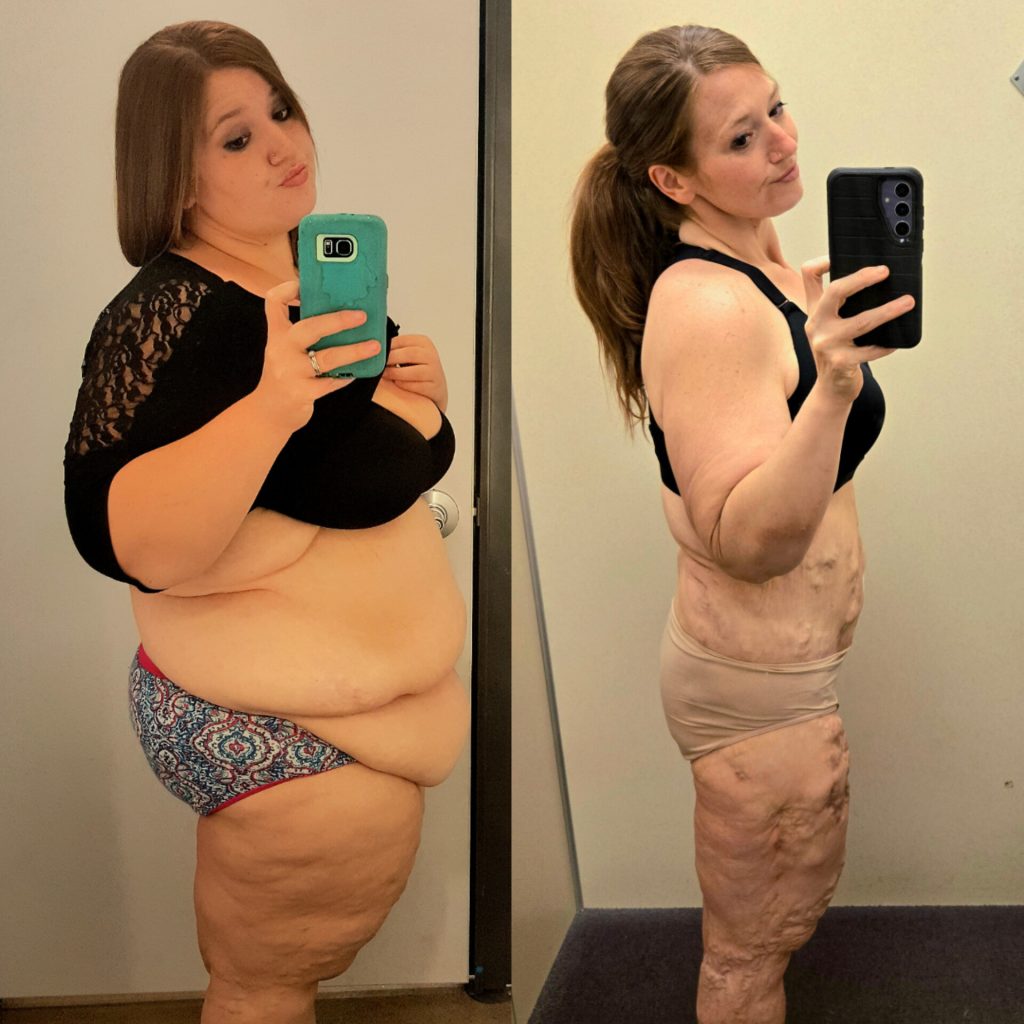 Lexi Reed lost 312lbs and now embraces her body with scars and loose skin from her battle with calciphylaxis - proud in swimsuits but unable to swim due to open wounds.