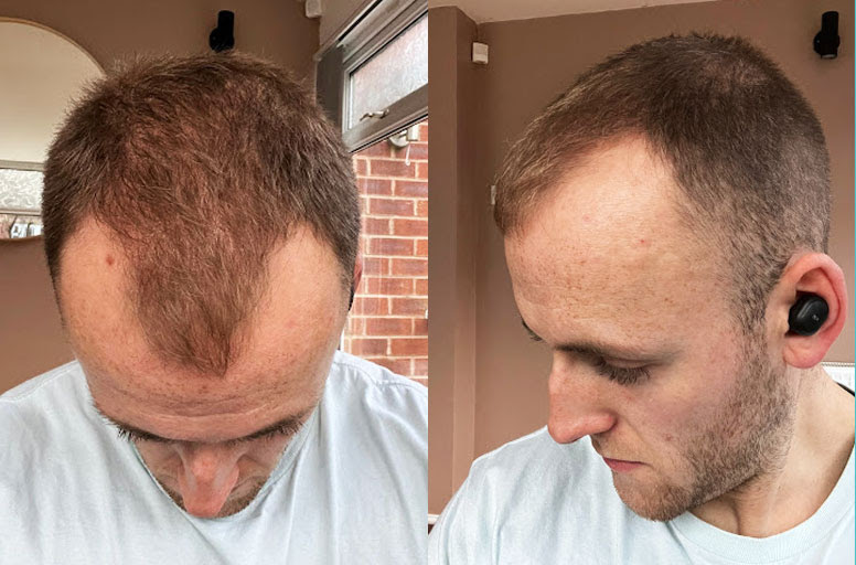 Bradley, once mocked for his hair loss, transformed his confidence with a 3,000 graft hair transplant in Turkey after years of struggles and a painful dating rejection.
