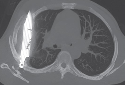 Doctors in Tanzania discovered a man had lived eight years with a knife blade in his chest after a violent altercation, removing it successfully and ensuring his full recovery.